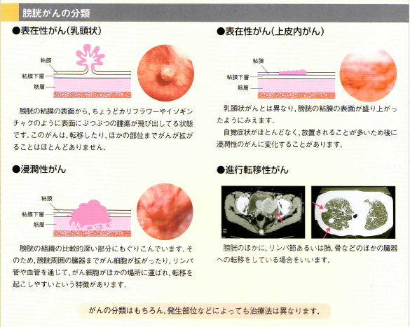 膀胱がんの分類